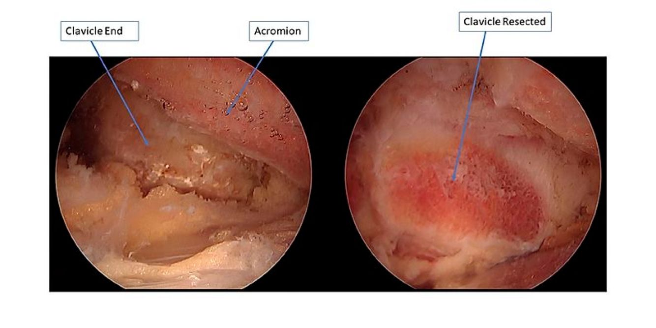 Arthroscopic before and after clavicle surgery by Orthopaedic Associates of Muskegon