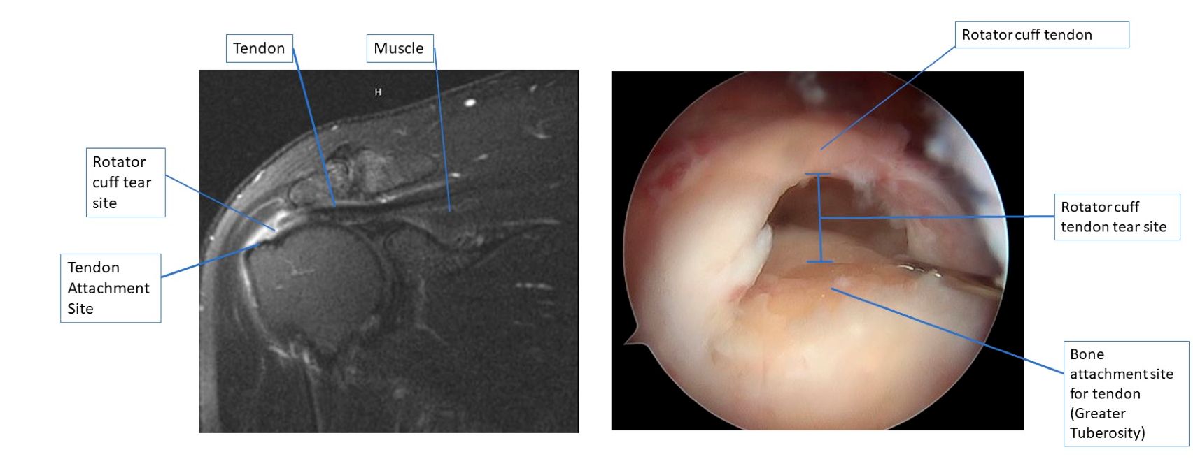 mri-images-of-rotator-cuff-tear.jpg