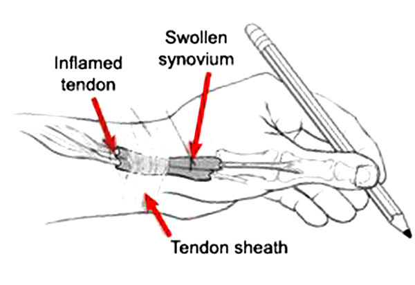 deQuervain's-Tendinitis