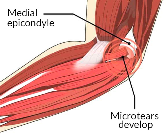 golfers-elbow-2