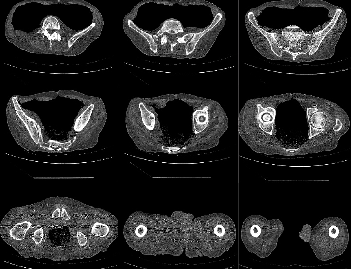 CT scan of hip