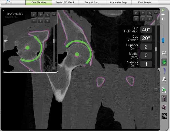 Hip digital x rays