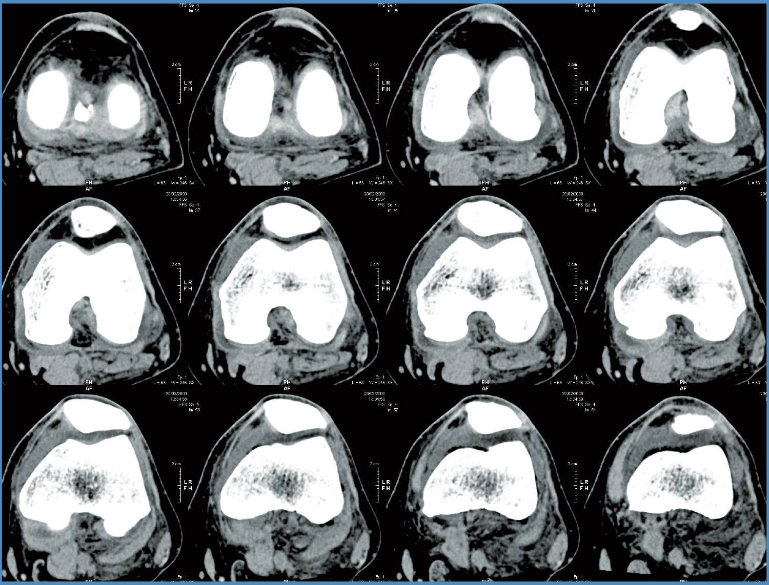 CT scan of knee joint